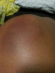 bad bruising left knww