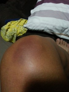 bad bruising right knee